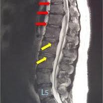 T10 Disc Herniation